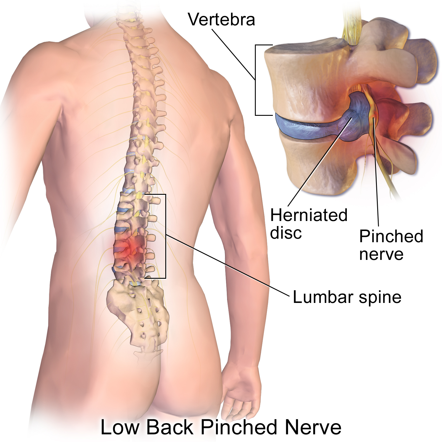 Low Back Pain