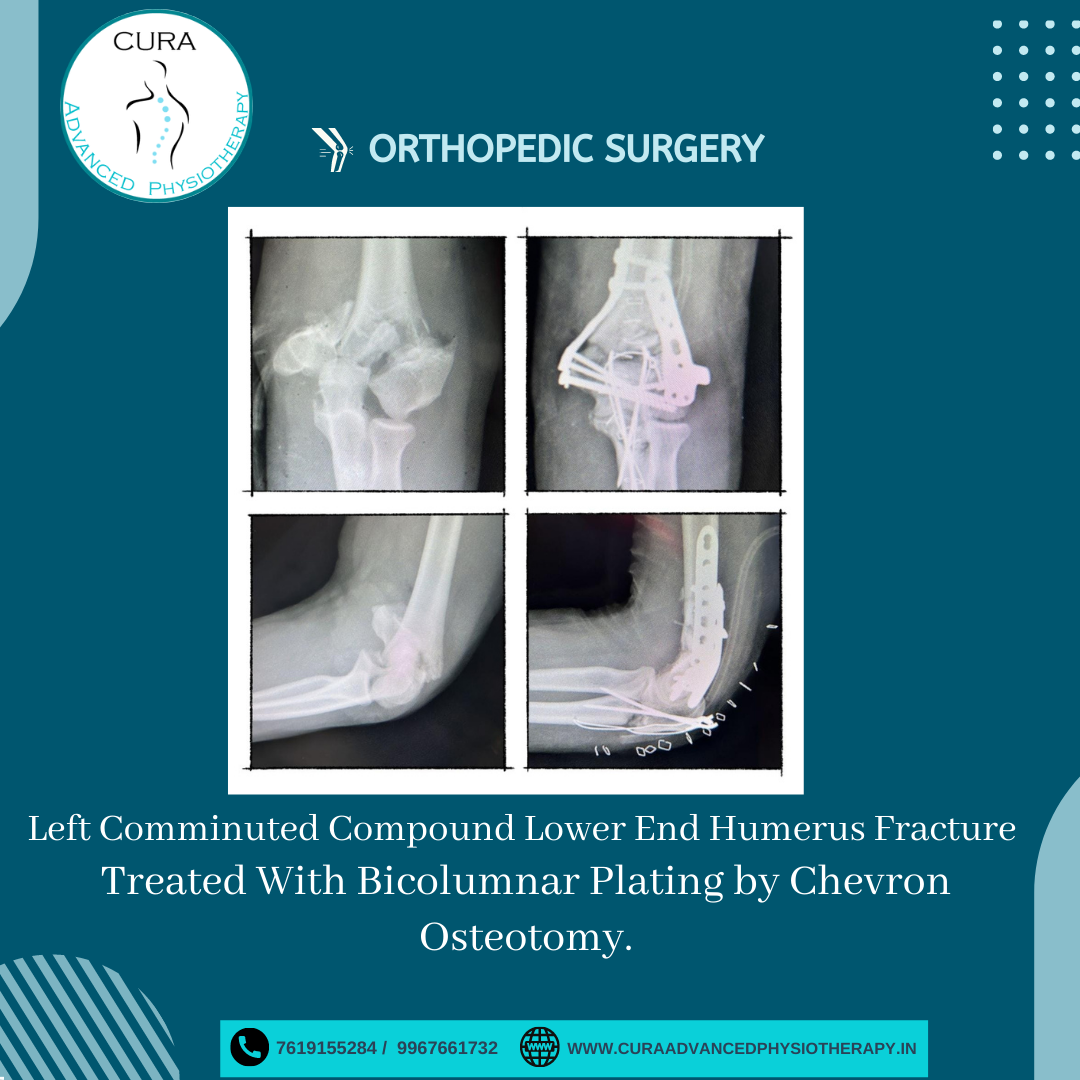 Fracture physiotherapy treatment at cura advanced physiotherapy 