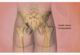 sciatica pain best Physiotherapy treatment