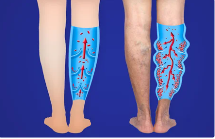 Varicose veins