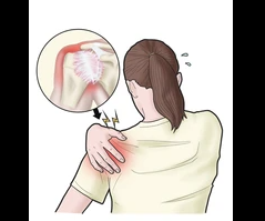 frozen shoulder physiotherapy
at cura advanced physiotherapy centers