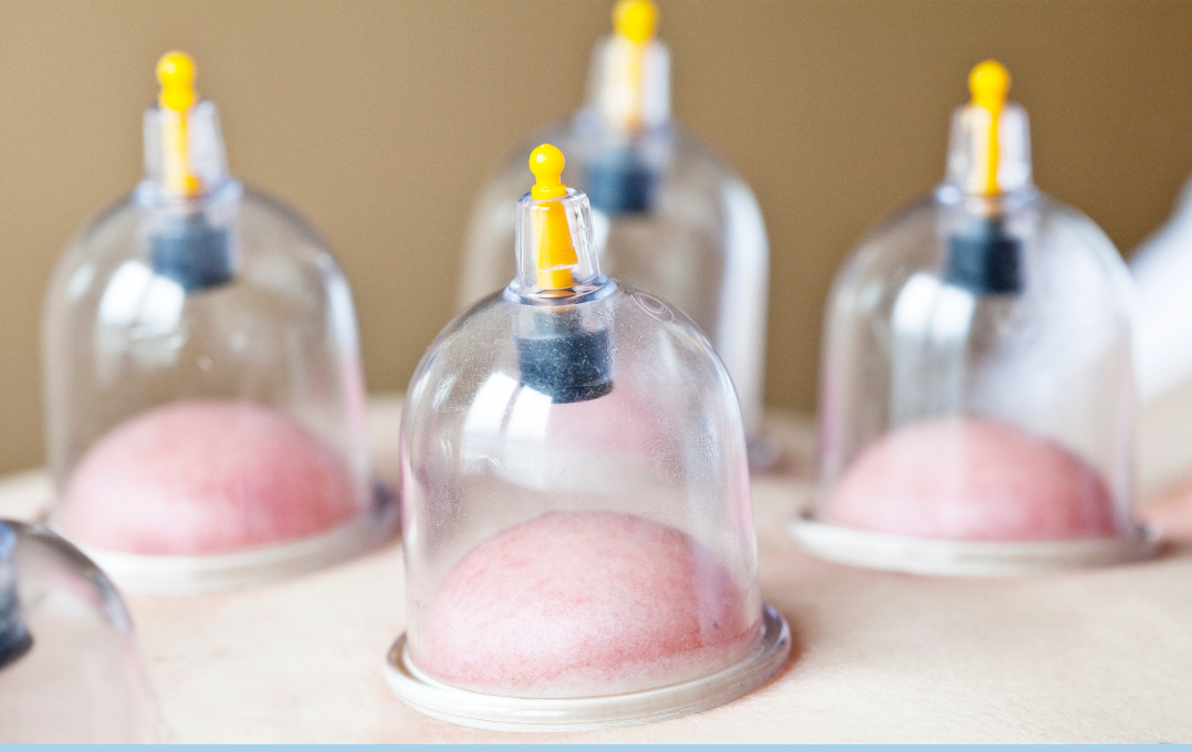 cupping therapy at cura advanced physiotherapy 