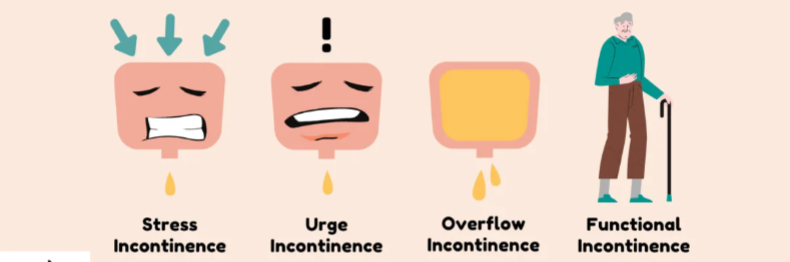 Image showing - Types of Urinary incontinence.
Stress Incontinence 
urge incontinence 
overflow incontinence 
functional incontinence 