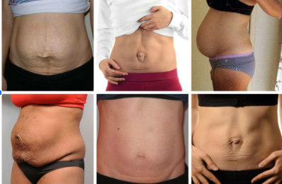 diastasis recti